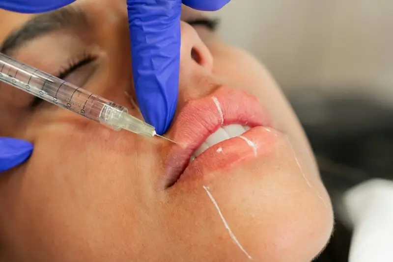 Close-up of lip filler injection procedure showing precise placement technique by trained professional