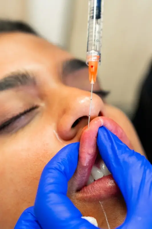 Practitioner performing lip filler injection demonstrating proper technique and safety protocols during treatment