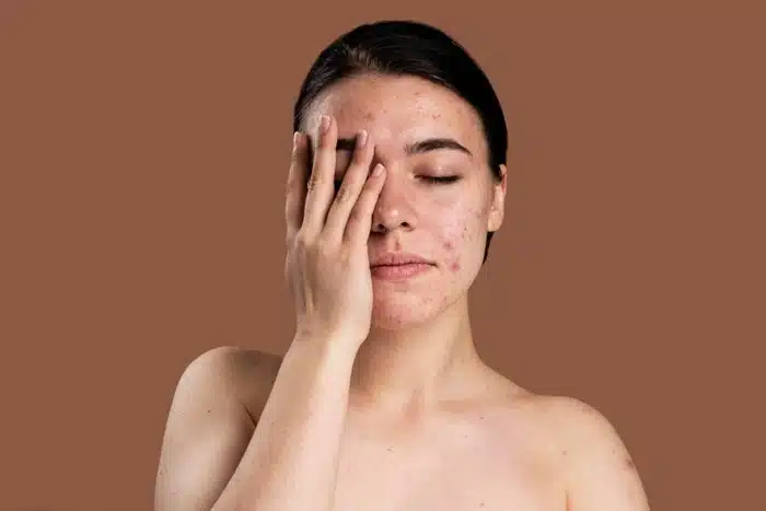 woman with persistent breakouts and acne-prone skin that won't respond to at-home treatment