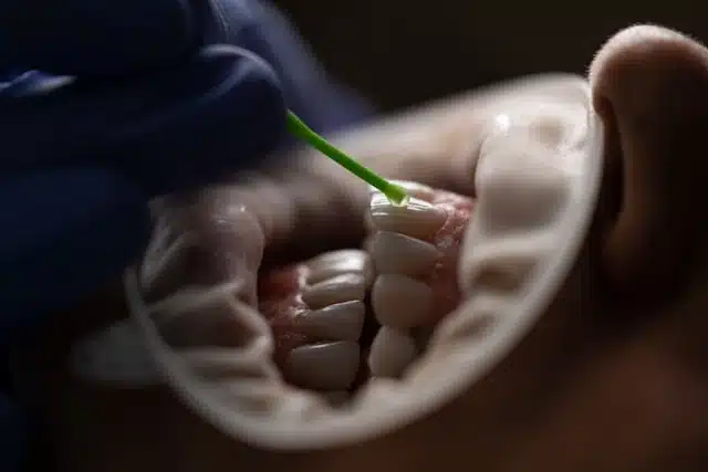 Close-up of dentist applying treatment to teeth using a cheek retractor during a dental checkup in Singapore