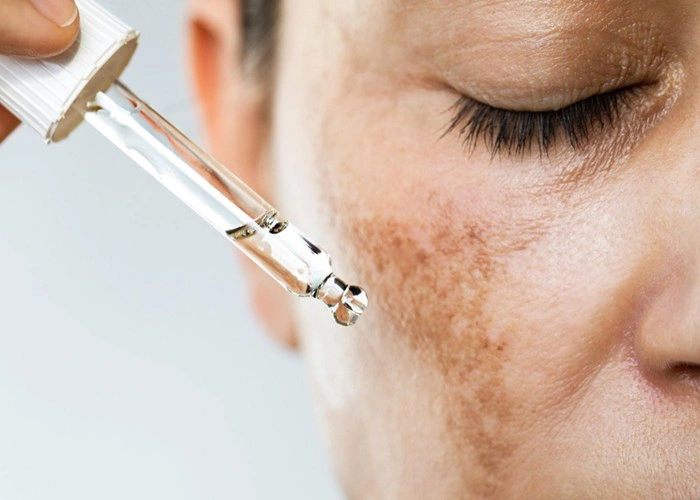 Close-up of a woman's face with visible melasma and dark spots as a serum dropper is applied to the skin