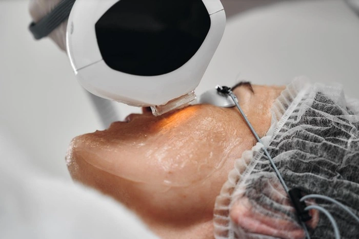 Close-up of a laser handpiece targeting the lower face and jawline of a woman wearing a surgical cap during a clinical skin treatment