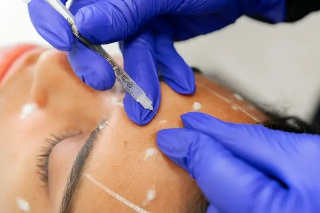 Close-up of a cosmetic procedure showing gloved hands using a precision tool near a person's eyebrow area, with white markings visible on the skin.