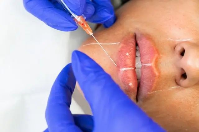 Close-up of lip injection procedure showing gloved hands using a syringe to administer treatment to lips with white guide markings visible on the skin.
