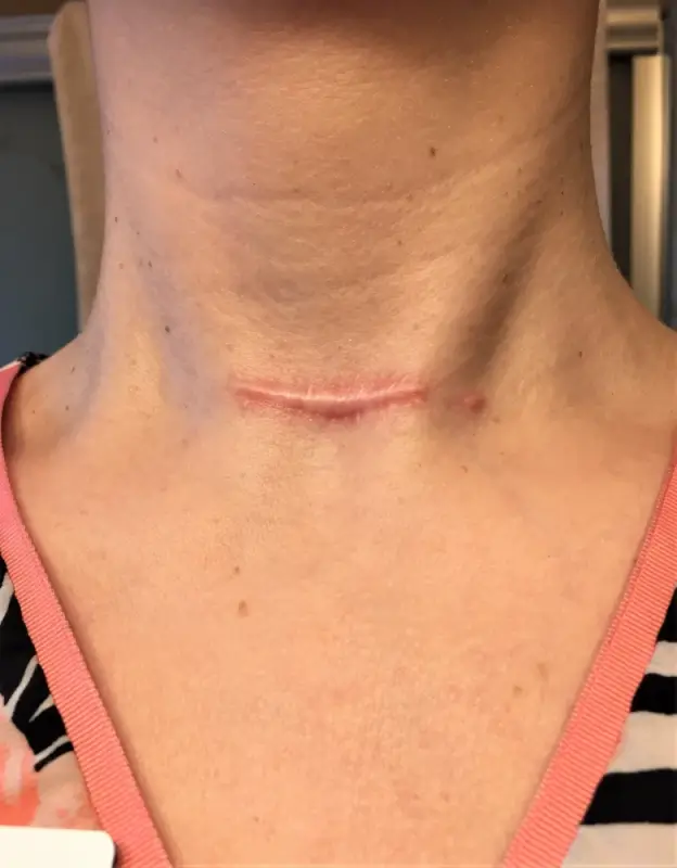 Healed surgical scar on neck showing successful wound recovery without hypertrophic scar formation