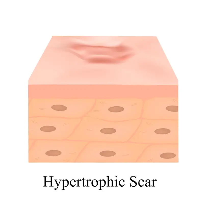 Illustration of a hypertrophic scar