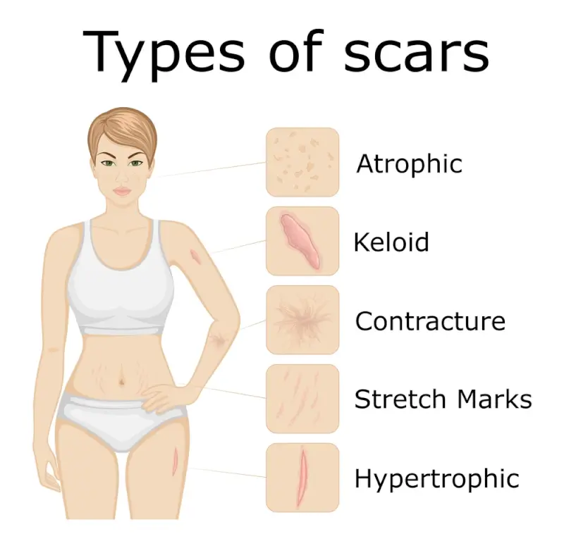 Medical infographic showing types of scars including atrophic, keloid, contracture, stretch marks, and hypertrophic scar formation